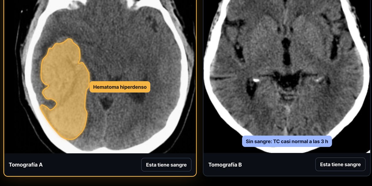 Atlas ENARM: dos tomografías de cráneo para comparar un EVC hemorrágico con uno isquémico.